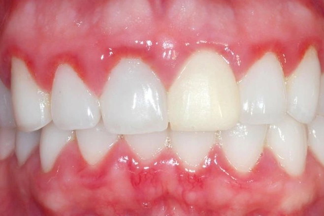 Sau khi bọc răng sứ bị viêm nướu bạn nên liên hệ nha khoa